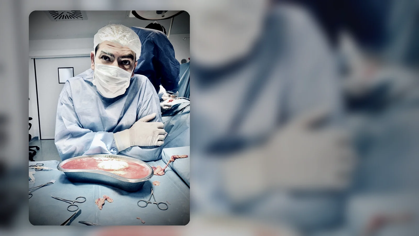 Böbrek nakli ameliyatı sırasında cerrahi hazırlık ve greft değerlendirmesini gösteren klinik görsel