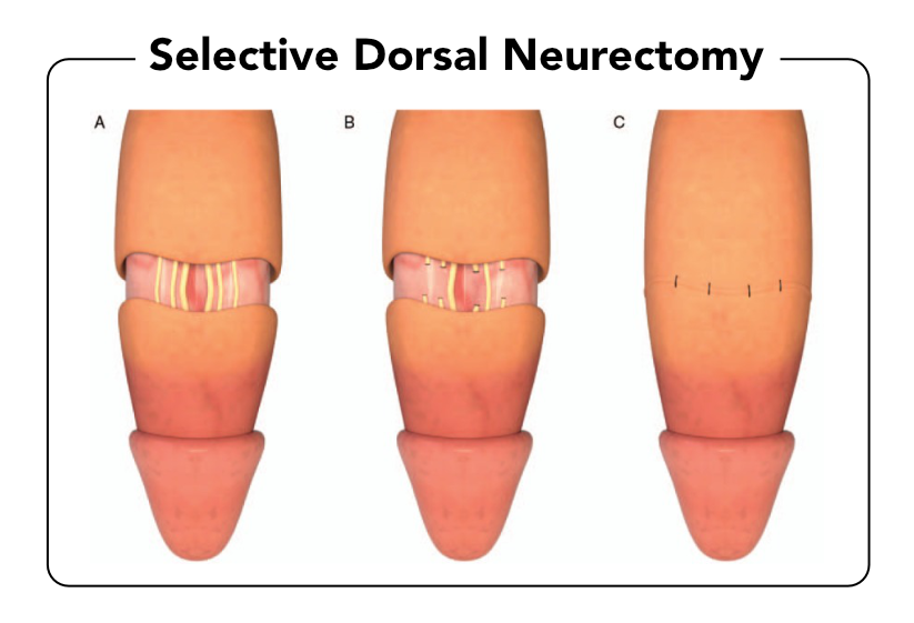 Selektif Dorsal Nörotomi