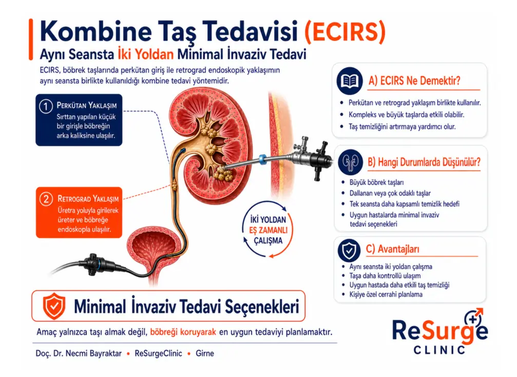 ECIRS yani kombine taş tedavisini anlatan infografik